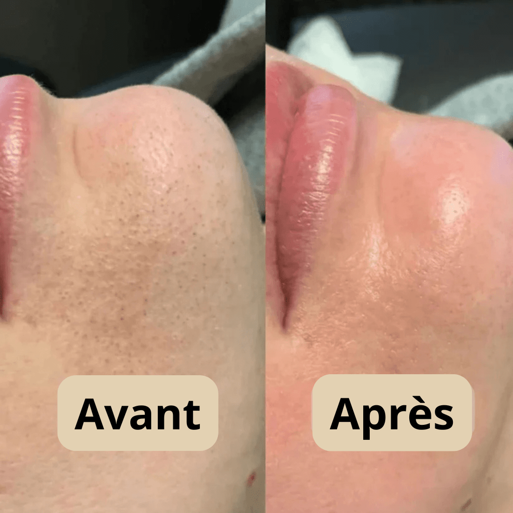 Peel Shot Coréen - Lumeva